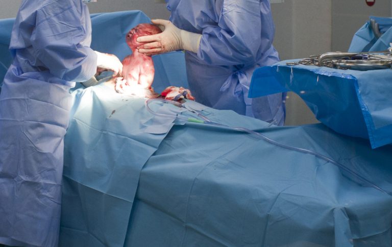 Elective Cesarean Is Gaining Popularity