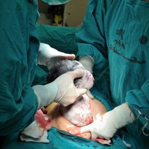 cesarean section