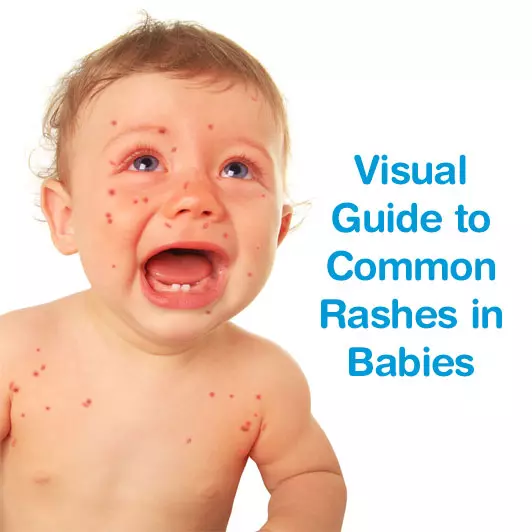babies rashes pictures